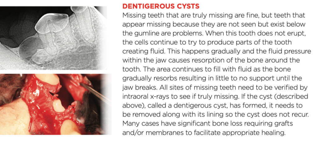 dentigerus cysts