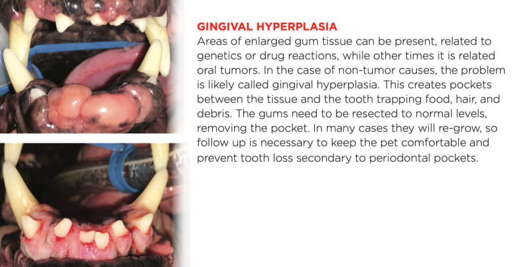 gingival hyperplasia