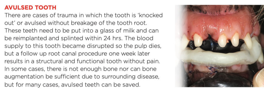 avulsed_tooth_1