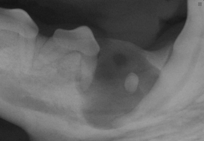 dentigerus cysts