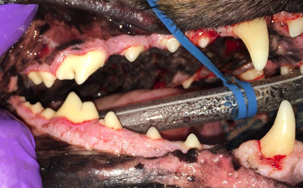 gingival hyperplasia