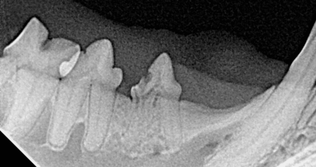 TOOTH_RESORPTION_3