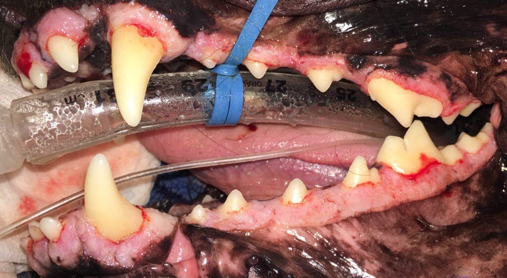 gingival hyperplasia