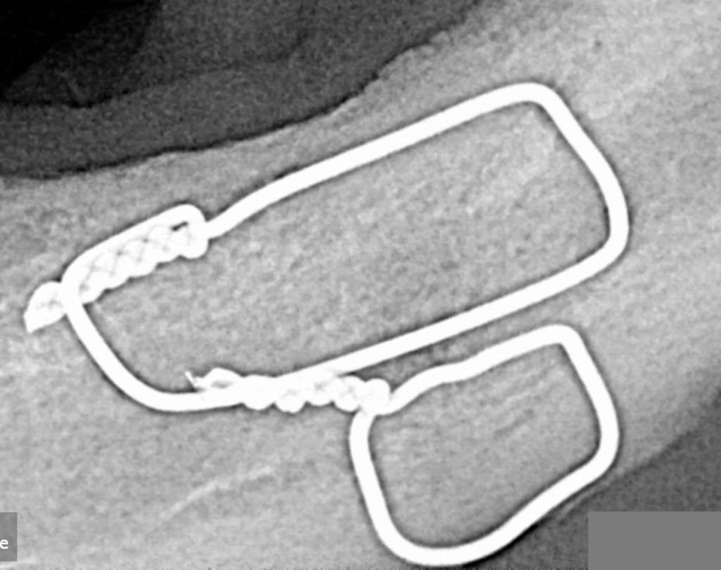 jaw_fractures_5