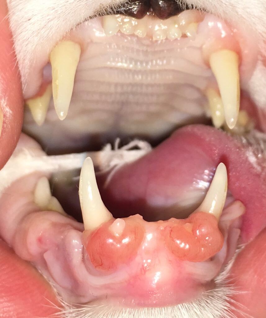 gingival hyperplasia