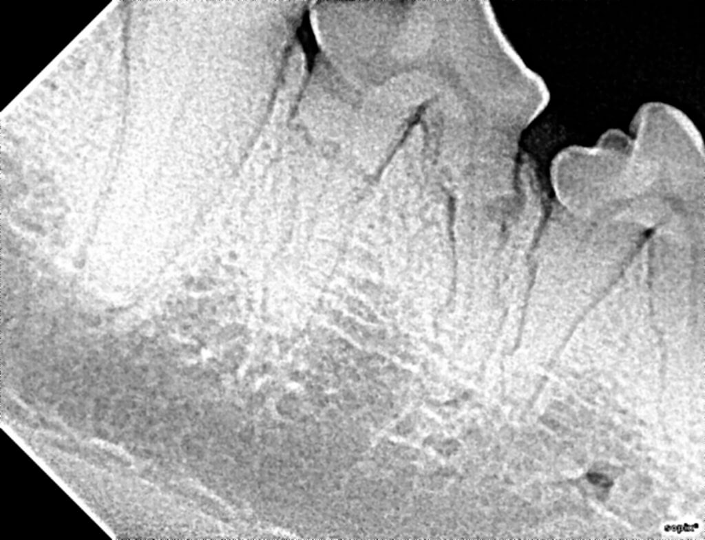 TOOTH_RESORPTION_6