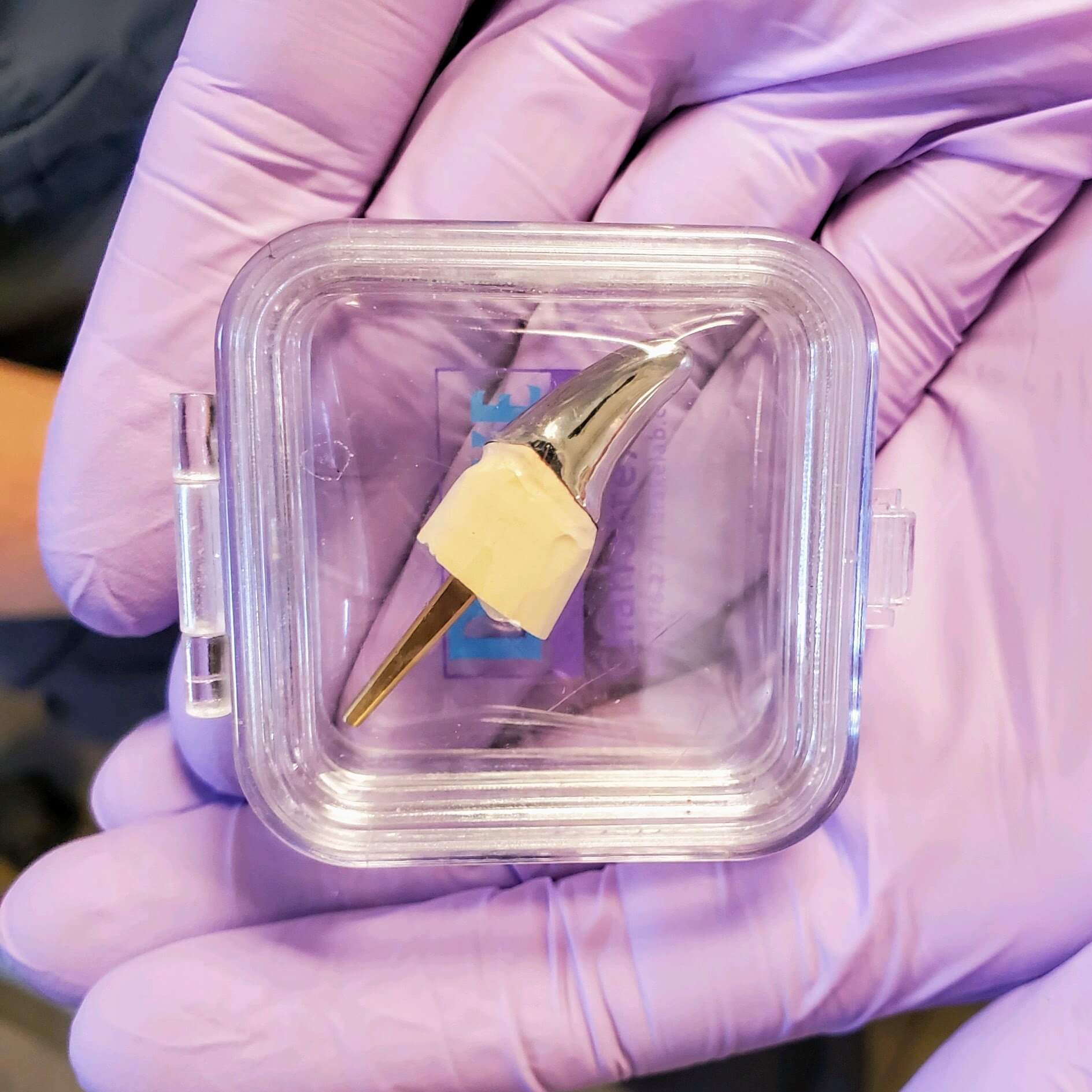 A Full Metal Crown before being placed on a Patient. 