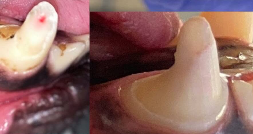 Broken tooth prepped for Crown installation.